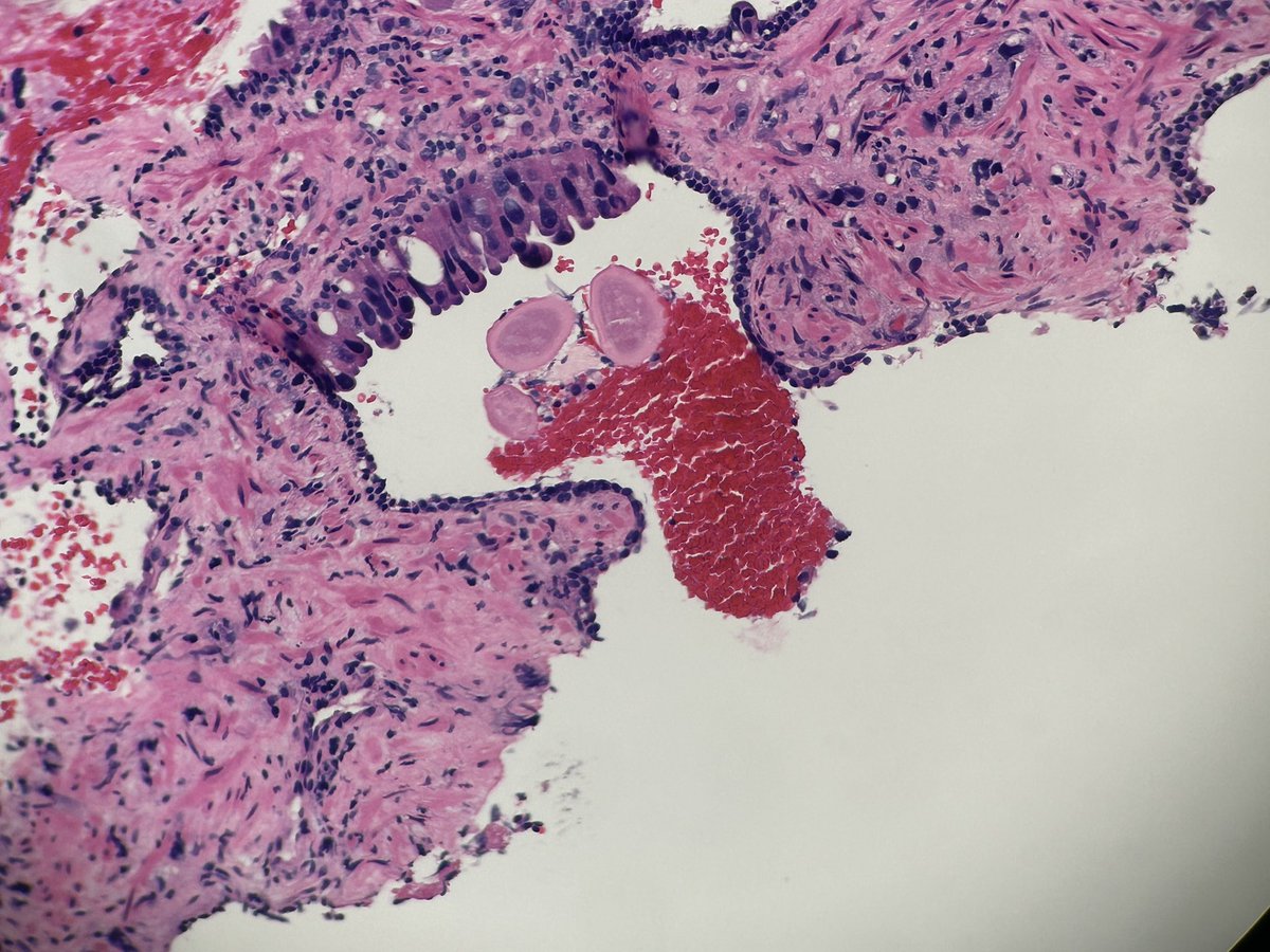 huda_rr1's tweet image. Intraductal carcinoma partially involving a duct? #prostate #GUpath