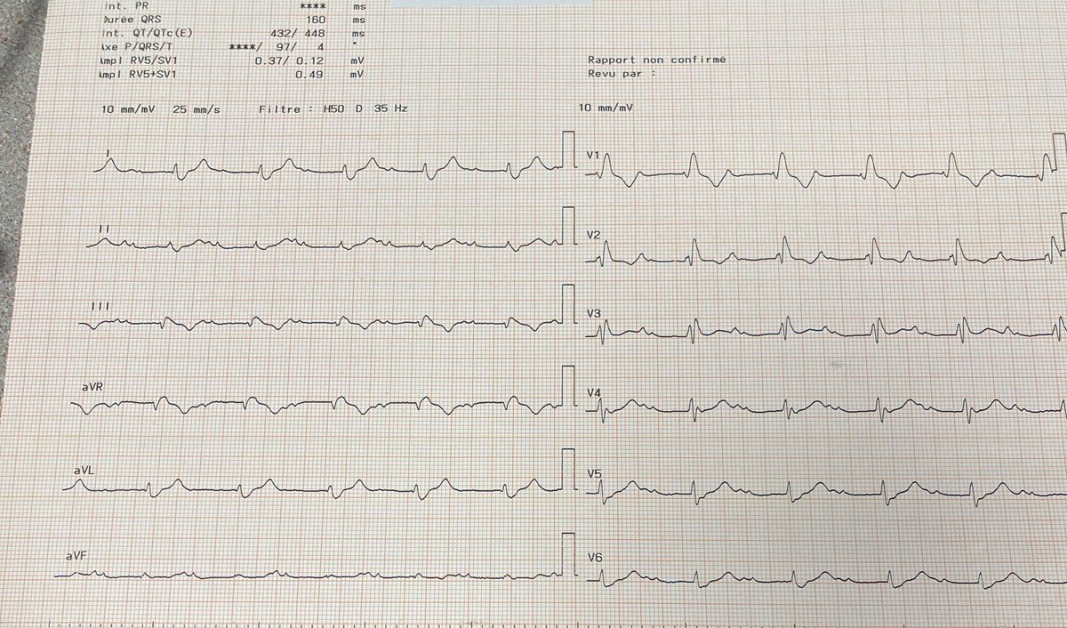 What do you think about ECG ⁉️⁉️⁉️
