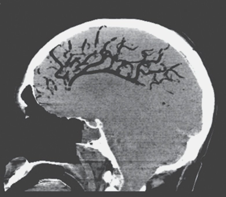 docakx's tweet photo. CT of a patient who developed neurodeficit after CPR. 

What happened? https://t.co/jmB3Z0uwTO