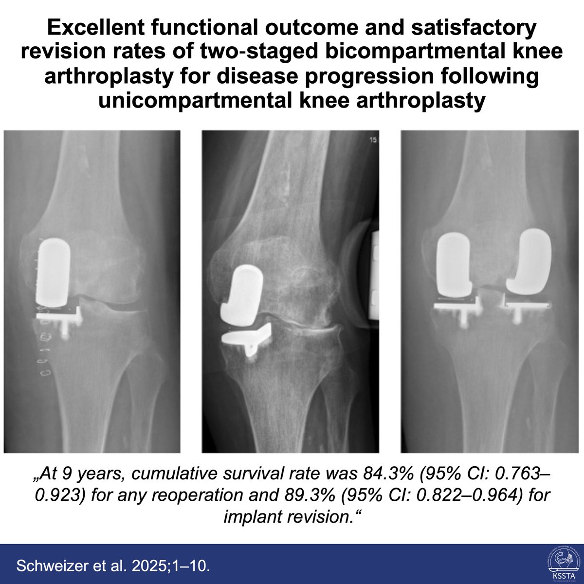 KSSTA's tweet image. Is adding a second compartment instead of converting straight to total knee arthroplasty after failed UKA a good idea?

#knee #arthroplasty #revision #outcomes #clinicalstudies #KSSTA

Read here: doi.org/10.1002/ksa.70…