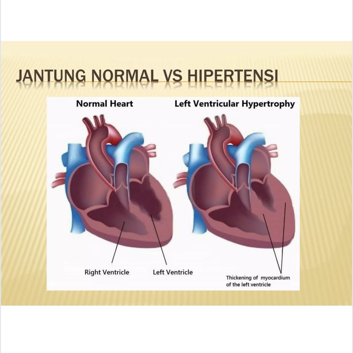 Saat Jantung Dipaksa Kerja Keras oleh Hipertensi

Bayangkan jantung seperti pompa air yang bekerja tanpa henti. Saat hipertensi terjadi, tekanannya naik, dan jantung dipaksa bekerja lebih keras setiap detik.

Lama-kelamaan, otot jantung menebal bukan karena kuat, tapi karena