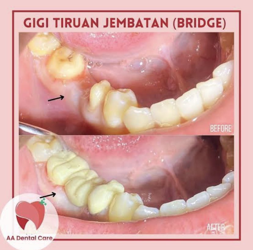 Kaylaaiy's tweet photo. Bagi teman teman dengan usia diatas 25 tahun yg memiliki keluhan ompong 1 gigi geraham bawah (seperti foto) &amp; ingin dibuatkan gigi palsu tiruan/bridge oleh dokter gigi muda/koas gigi RSGM daerah Jakarta Barat tanpa dipungut biaya boleh komen dibawah ya😊🙏🏻 #caripasien #koasgigi https://t.co/Aj9viDhq4s