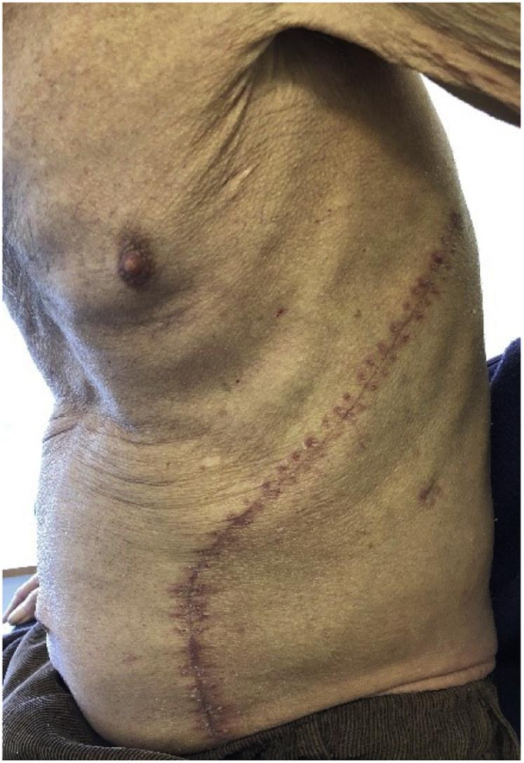 TrackYourHeart's tweet photo. An oblique scar extending from chest to abdomen
What surgery does this scream? https://t.co/aa9ltPpCMv