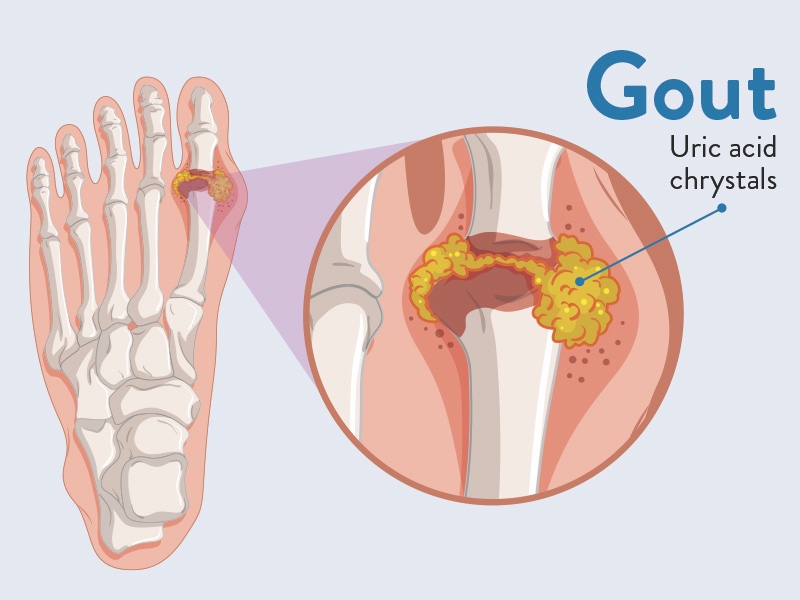 ProfSirera's tweet photo. How many times have you heard, read—or even said—that gout is caused by “uric acid crystals accumulating in the joints”? 

It is a convenient image. 
Visual. 
Intuitive. 
And, in a strict mechanistic sense, misleading.

What is often overlooked is that the central player is not uric acid per se, but urate, its ionised form at physiological pH. In plasma and tissues, uric acid exists predominantly as monosodium urate. And crucially, the joint is not a test tube: concentrations, ionic strength, and pH rarely favour the formation of the large, well-defined crystals we associate with urinary sediment.

Instead, what emerges are microscopic, often transient crystalline or subcrystalline structures, sometimes below the threshold of classical detection. Yet their biological impact is disproportionate.

Here is the key shift in perspective.
Urate behaves as a DAMP (Damage-Associated Molecular Pattern). These are endogenous molecules that signal “danger” to the immune system, not because they are foreign, but because they appear in the wrong place, at the wrong concentration, or in the wrong context.

Extracellular urate can be sensed by innate immune cells, especially macrophages. 
Upon uptake, urate triggers activation of the NLRP3 inflammasome, a cytosolic multiprotein complex that acts as a molecular switch for inflammation. This leads to caspase-1 activation and the maturation and release of IL-1β, one of the most potent pro-inflammatory cytokines.

From there, the cascade amplifies. 
Neutrophils are recruited. Vascular permeability increases. The joint becomes a confined inflammatory niche. Pain, swelling, and erythema are not the passive consequence of “crystal deposition”—they are the result of a highly orchestrated innate immune response to a perceived danger signal.

Interestingly, the requirement for large crystal formation is minimal. The immune system does not need macroscopic structures; it responds to physicochemical cues and particulate signals at the micro- and nanoscale.

At its core, gout is not a problem of precipitation in the classical chemical sense—it is a problem of immunological interpretation. 
Urate is not just a metabolite. 
Under certain conditions, it becomes a message. 
And the joint, exquisitely sensitive to that message, responds with inflammation.