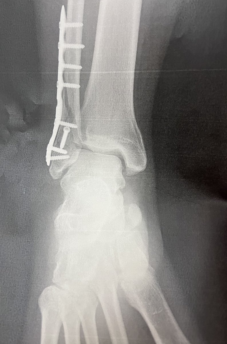 ✌︎('ω'✌︎ )ハゲゾウ( ✌︎'ω')✌︎ ダルみざわ症候群 tweet media