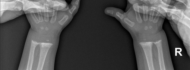 drobiy12's tweet image. Saw this beautiful case 

A 16 month old child reluctant to walk despite receiving the best of care and was exclusively breast fed. 
Requested blood tests and investigations. 
What could be happening ? 
Take a wild guess. 

#MedTwitter #MedX #MedEd #FOAMed #NephroTwitter