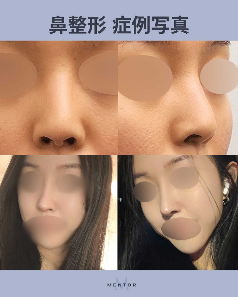 mentorjp's tweet photo. ✨お顔全体のバランスを整える鼻整形

✓ 顔全体のバランスを考えたナチュラルな仕上がり
✓ 立体感のあるはっきりとした印象へ
✓ 一度の施術で長期間の効果が期待
✓ 低い鼻・わし鼻・曲がった鼻・鼻先の下がりなど、複合的なお悩みに対応可能
 
📱【質問・予約】 LINE https://t.co/sntEINelcU https://t.co/7sRxouuu7L