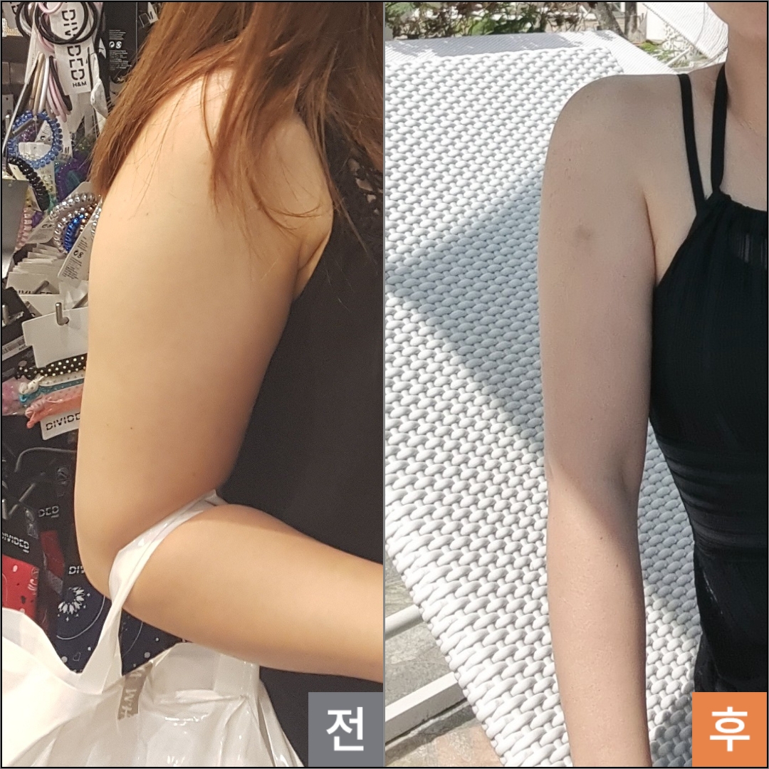 脂肪吸引専門365mc│韓国NO.1症例数600万件以上│大容量脂肪吸引│韓国整形│ tweet media