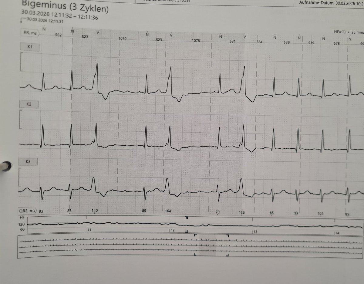 IrmaMDv's tweet image. Thank goodness there's a bigeminus!😀

Would you mind telling me what you see?