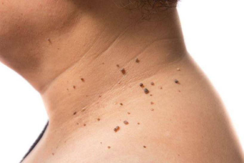 7 signs you're chronically stressed (&amp; don't realize it):

1. Skin tags.