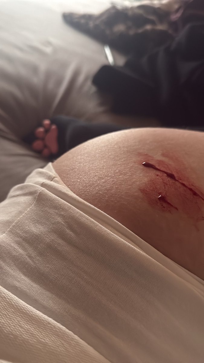 bunnispaws's tweet photo. Look how pretty >_< #cuts #pawsocks #me #shtwt #selfharm #sh https://t.co/ZQASxsVuiu