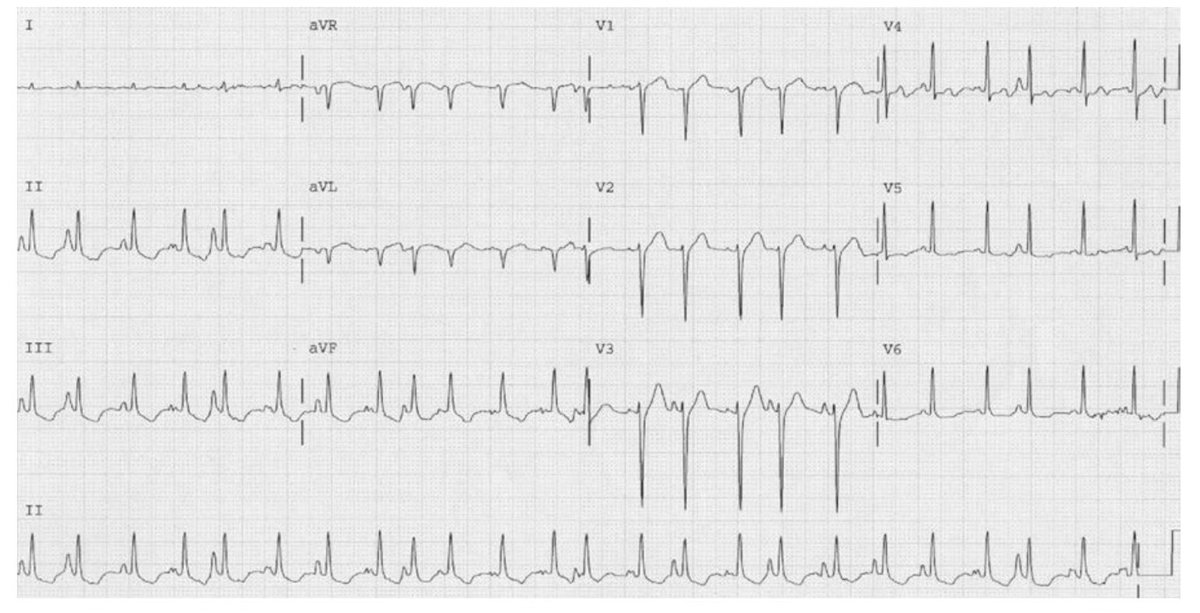 Dr_Shiv_kumar_'s tweet image. 🚨 🫀 ECG case alert 

38 year old patient with the history of smoking comes with the complaint of SOB &amp;amp; palpitation, ECG is obtained how would you analyse this rhythm? 

RR- 21
SPO2 - 95% 
BP- 120/90mmhg 
PR- 90 bpm 

#MedTwitter #ECG #MedX
