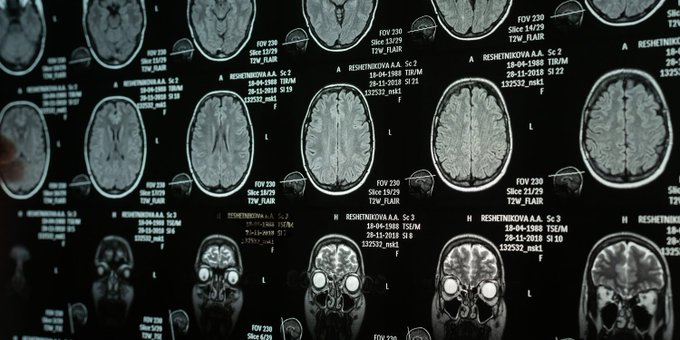 OwenGregorian's tweet image. Narcissistic traits are linked to a brain area governing emotional control | Karina Petrova, PsyPost

A recent study reveals that the physical structure of a specific brain region acts as a bridge between narcissistic personality traits and the habit of hiding one’s emotions. By