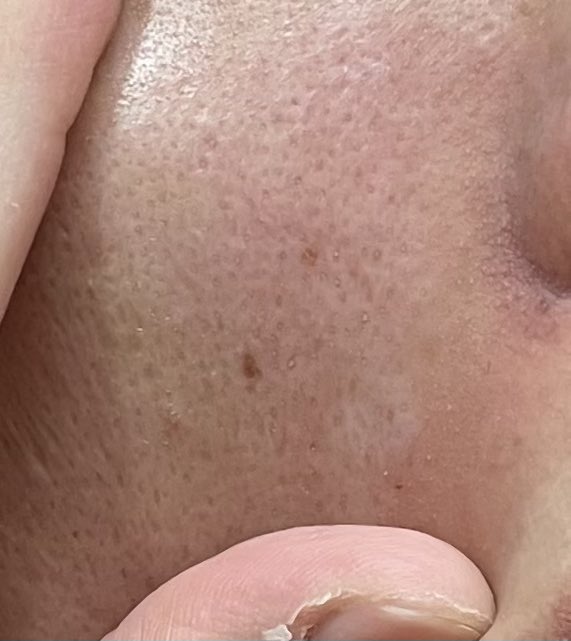 bokko__u's tweet image. 皮脂民をナメるな😡😡😡（クレンジング、洗顔の後、濡れタオルで少し擦って角栓を除去した後の肌）