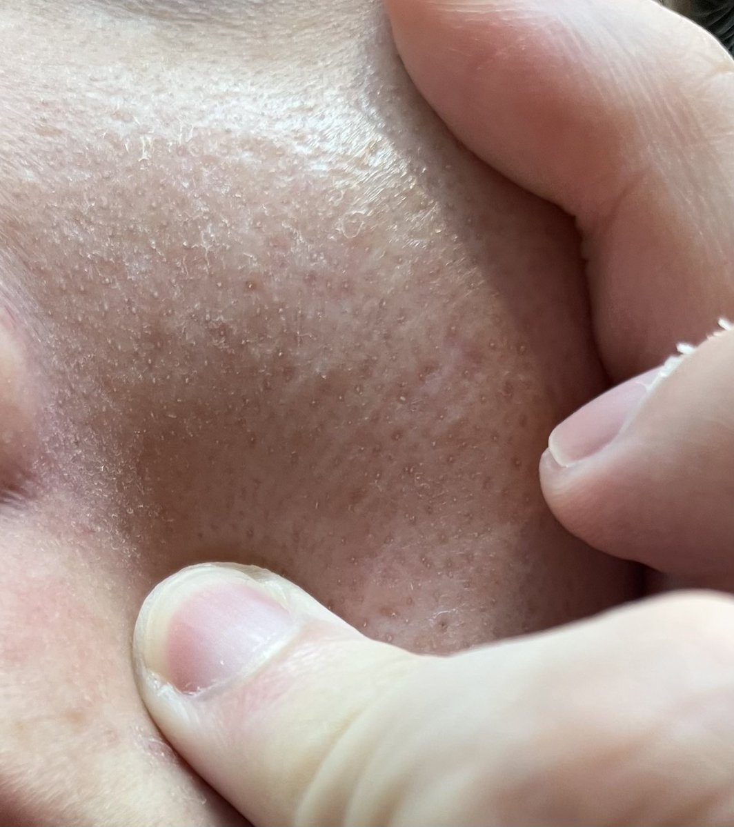 bokko__u's tweet image. 皮脂民をナメるな😡😡😡（クレンジング、洗顔の後、濡れタオルで少し擦って角栓を除去した後の肌）