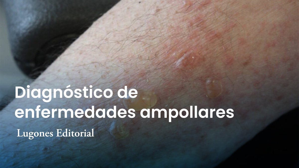 lugoneseditor's tweet photo. Enfoque múltiple: evaluación clínica, histopatología, inmunofluorescencia y serología.
🔍 La inmunofluorescencia directa sigue siendo el estándar de oro diagnóstico.