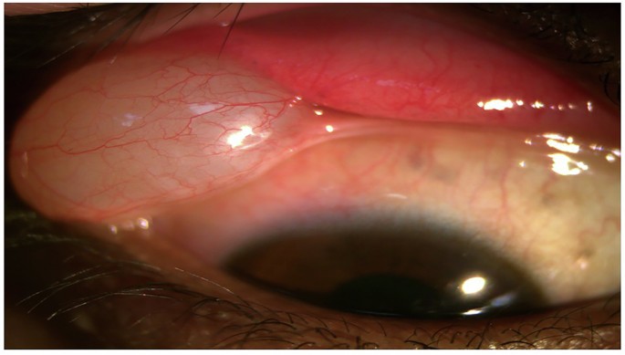 ophthopedia's tweet image. Ophthopedia Update: Superior forniceal conjunctival epithelial cyst with a frog-belly configuration dlvr.it/TS17xb #Ophthalmology #Eye #Ophthotwitter