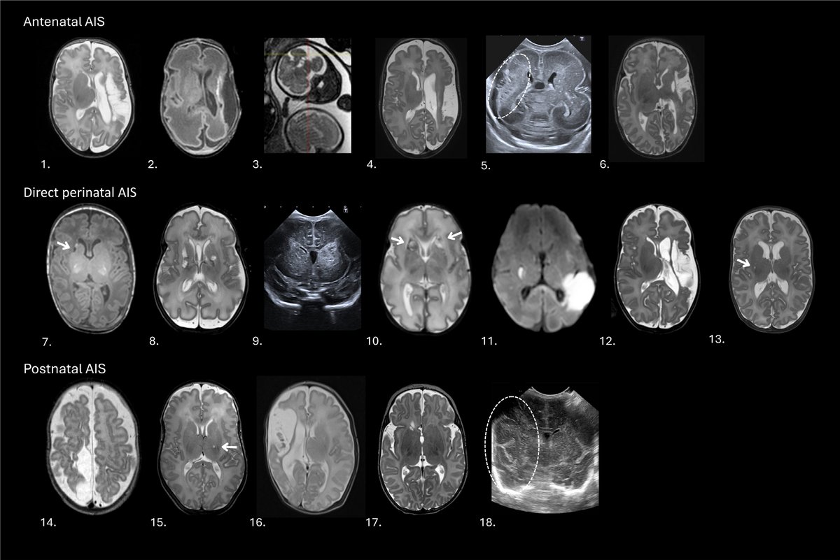 StrokeAHA_ASA's tweet image. Perinatal Arterial Ischemic Stroke in Monochorionic Twins: When and Why?

In this #BloggingStroke post, @JohannaSeidenMD discusses #Stroke article by van Oldenmark et al. @UniLeidenNews @UniLeiden

ahajournals.org/do/10.1161/blo…