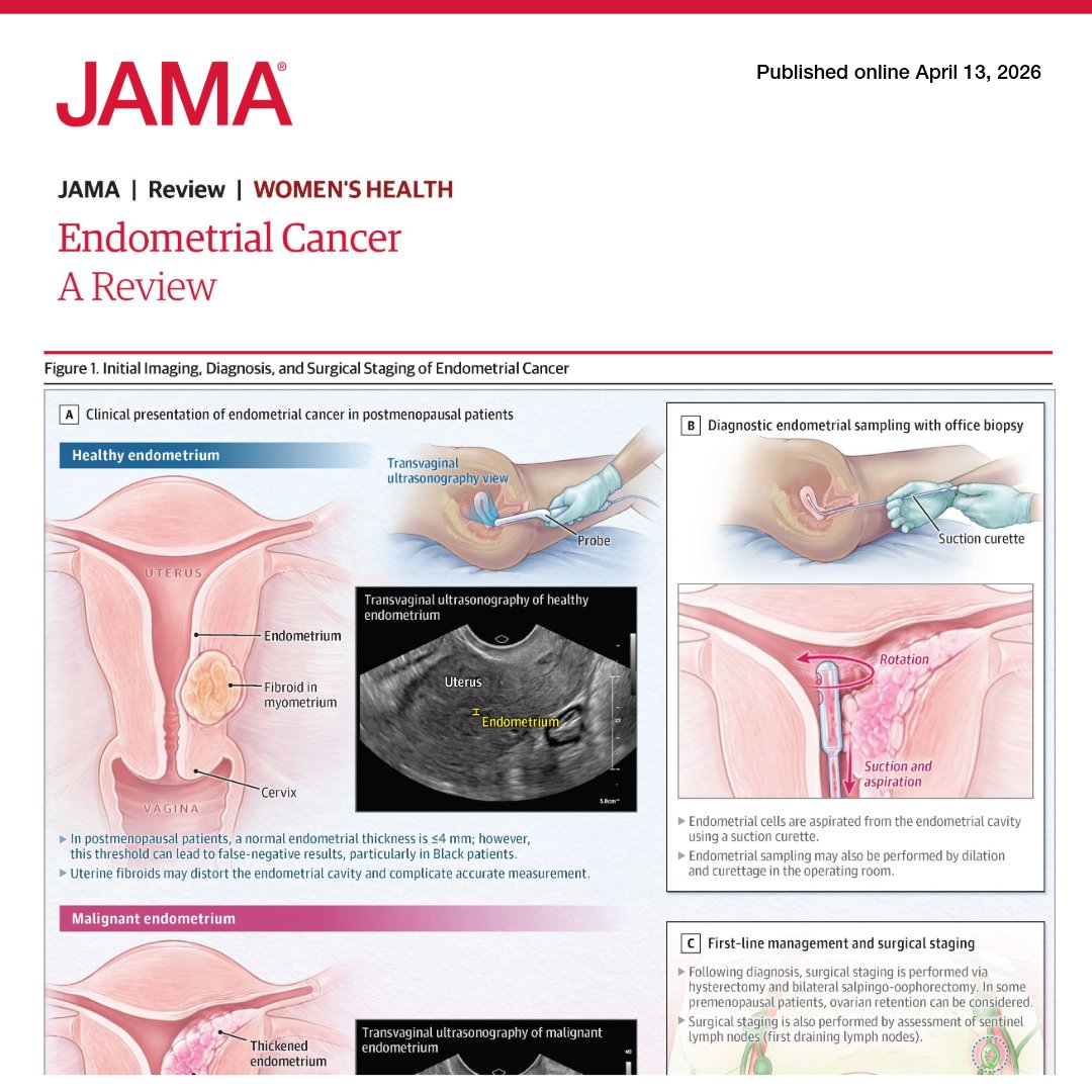 JAMA_current's tweet image. Uterine cancer is the fourth most common cancer in women in the US, with an estimated 68 270 new cases and 14 450 cancer deaths projected to occur in 2026. 

📄 This Review summarizes the epidemiology, clinical presentation, and diagnosis of endometrial cancer.