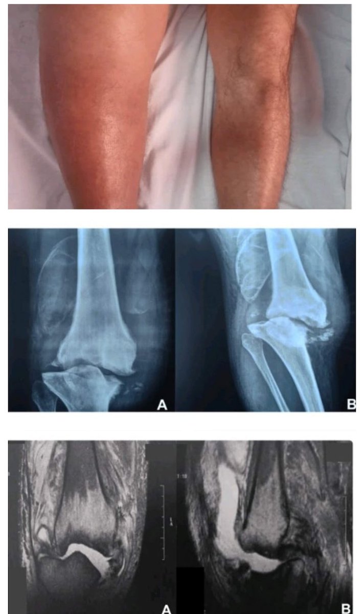 reinmd77's tweet photo. 62yrs♂️9mths knee swellg ⬇️ROM
CRP ESR⬆️
🔬🧫💎🚫
🎞️❗
🔑🚫⚡⚡🚫
Hx unprotec++sex
🆕⬇️esthesia areflexia atax
TPHA⊕,VDRL⊖(past syph)
◾ Hypertroph Tabetic Arthropathy
💊 CRP swellg ⬇️

https://t.co/kFdM9XX6BL https://t.co/Flt8IhU7Sj