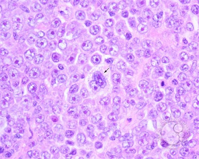 sanamloghavi's tweet image. Diffuse Large B-cell Lymphoma, Anaplastic Variant submitted by John Lazarchick. IHC shows diffuse strong CD20 expression.  #MedEd #Hematology #ASHImageBank #hemepath 🔬🧬 @artsinyc @KMirza @ASH_hematology  imagebank.hematology.org/image/1992