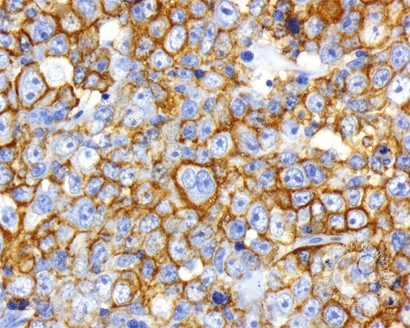 sanamloghavi's tweet image. Diffuse Large B-cell Lymphoma, Anaplastic Variant submitted by John Lazarchick. IHC shows diffuse strong CD20 expression.  #MedEd #Hematology #ASHImageBank #hemepath 🔬🧬 @artsinyc @KMirza @ASH_hematology  imagebank.hematology.org/image/1992