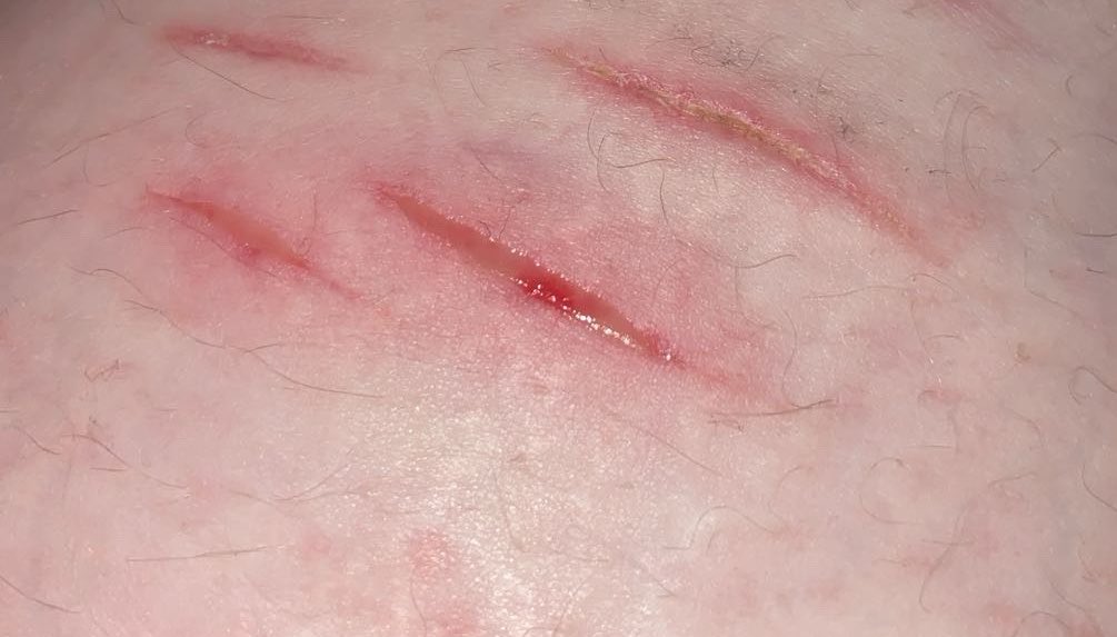 mymelcals's tweet photo. Guys pls help is this cut infected I can’t tell it had yellow stuff on bandage when I took it off
Shtwt | slitwt | shedtwt https://t.co/4Mm2D4XwW6