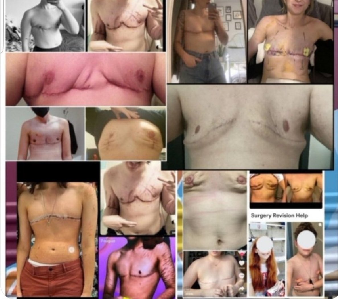 They are telling young girls that they are not good enough. 

Then they butcher them. 

This is not ‘gender affirming care’ - this is butchery of traumatized, autistic, and anorexic girls.