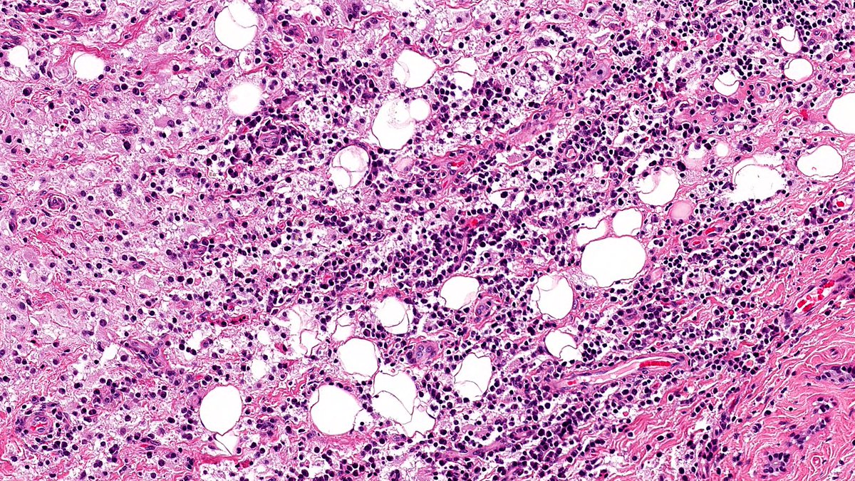 RazaHoda's tweet image. Let’s review histiocytic lesions this week! The hungry hungry hippos of the human body🦛

Rosai-Dorfman-Destombes Disease of Breast🔬

Sheets of large histiocytes with abundant pale cytoplasm showing emperipolesis.

#PathX #PathTwitter #breastpath