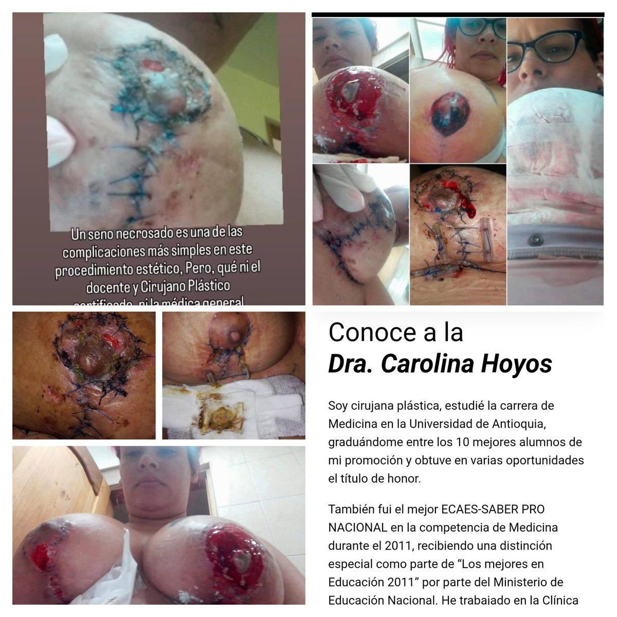 jimmysamantha50's tweet photo. @solsilvanazb @UdeA Así me dejo Carolina hoyos rave una de las mejores medicas de la @UdeA https://t.co/ck6q3mJ9dI