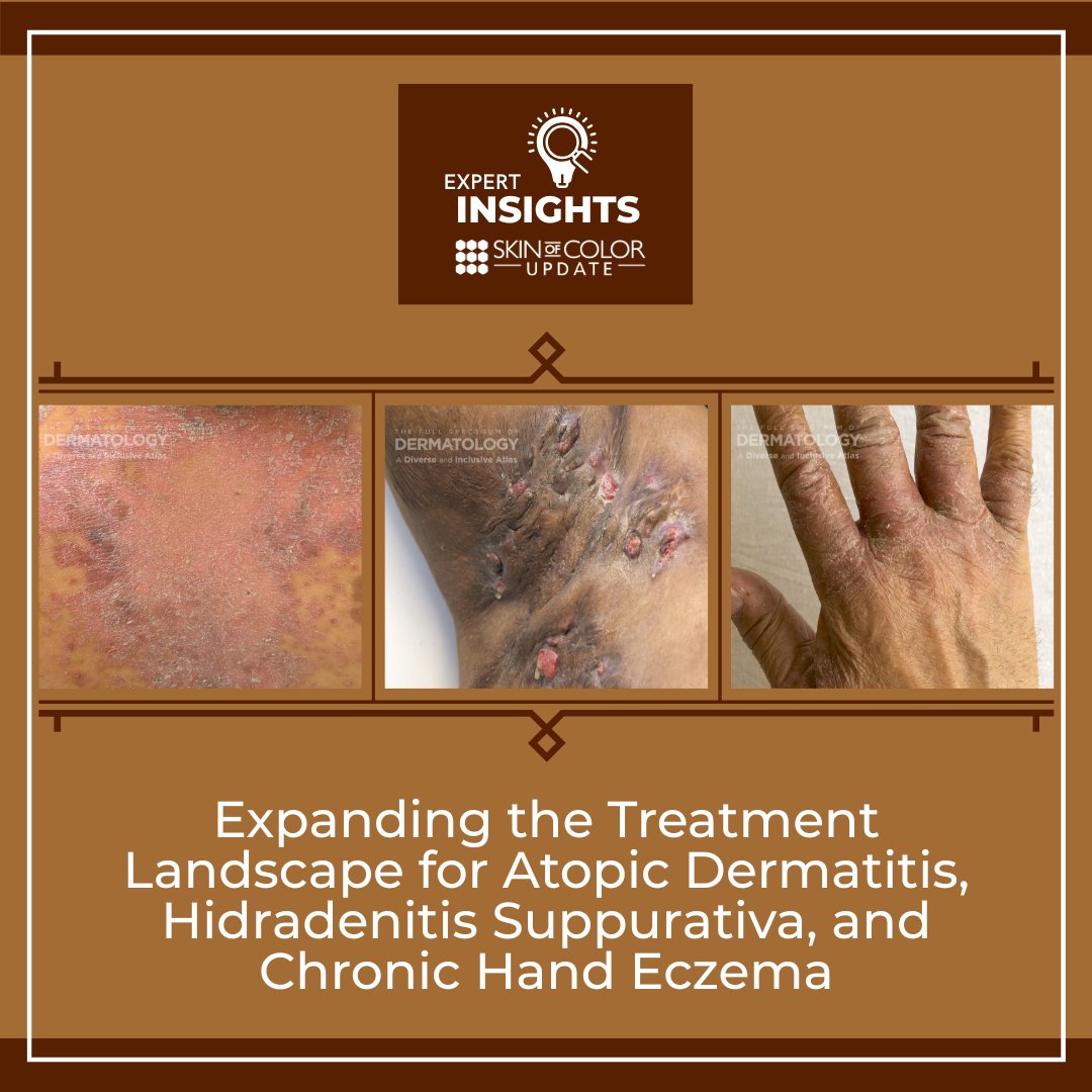 SkinOfColorDerm's tweet photo. A wave of FDA approvals expands options for inflammatory skin disease:
https://t.co/A83guq1qM5
#Dermatology https://t.co/cpGYuOqY9d