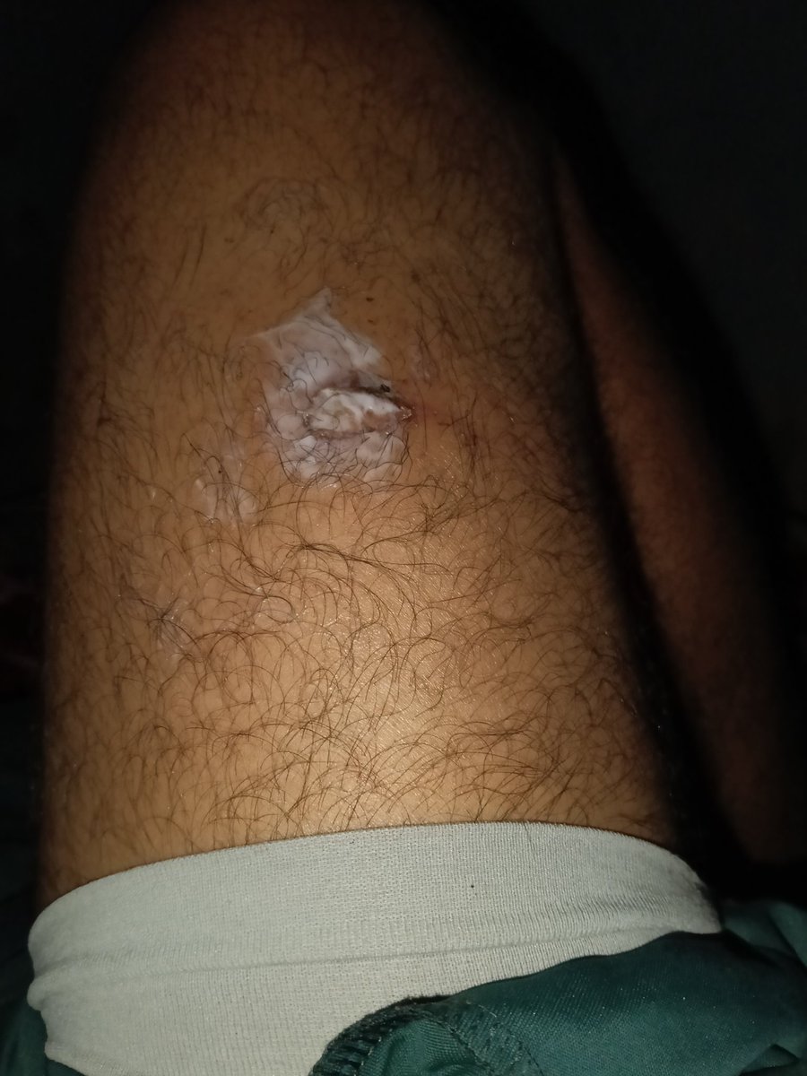 King103445's tweet image. Mera Motorola phone aaj apne aap phat gaya jiski wajah se mera pair jal gaya hai. Kya customer ki jaan ki koi keemat nahi hai? @MotorolaIndia, please look into this immediately. I'm lucky it wasn't worse. 📸 [Photos attach karein] #MobileExplosion #MotorolaIndia #Justice"