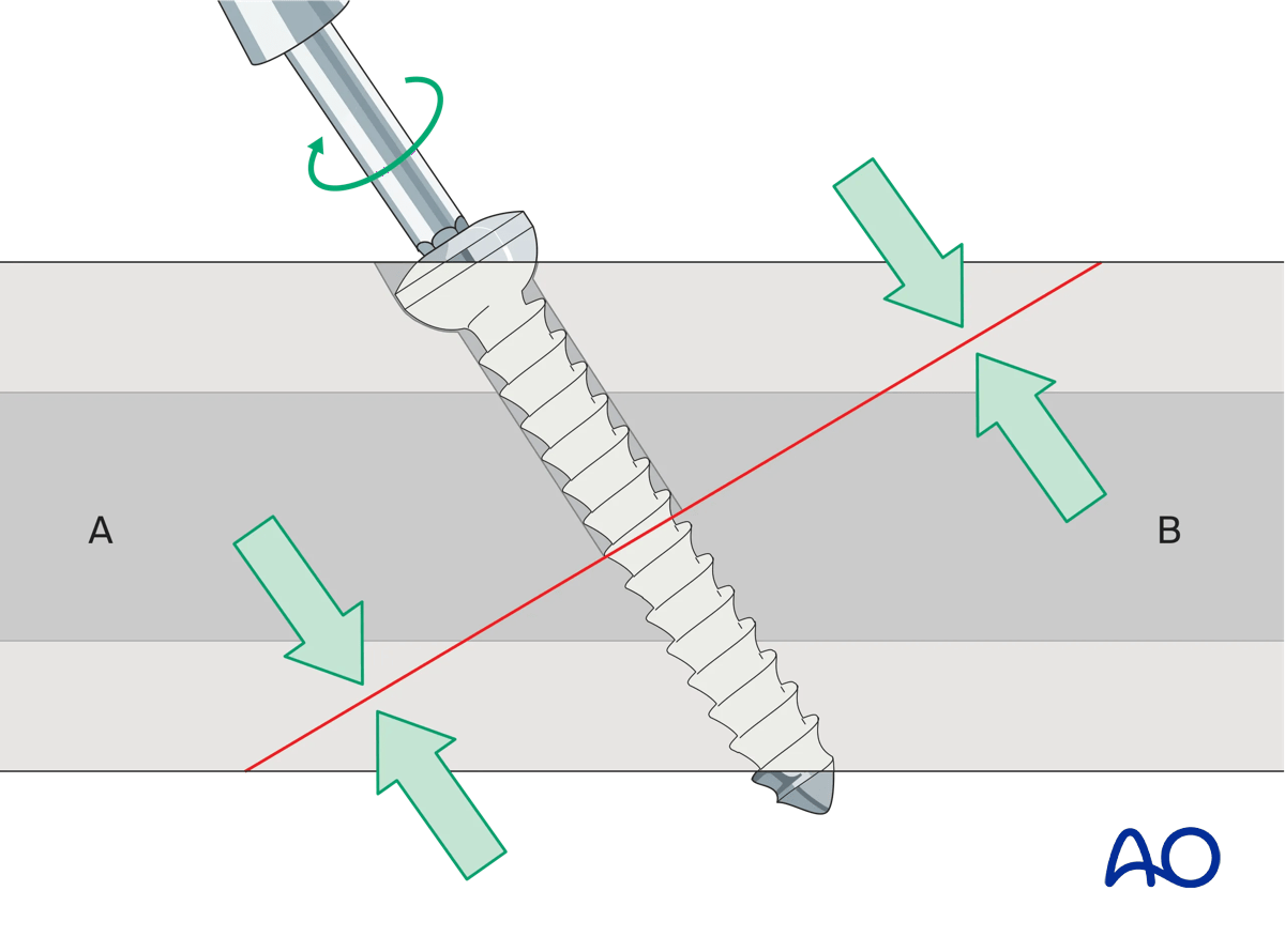 AOSurgery's tweet photo. 🐾 Now live on AO Surgery Reference: Reorganized Basic Techniques for Dogs &amp; Cats 🐾

➡️ https://t.co/LgZICamOLu

#AOSurgeryReference #AOVet #VeterinaryTrauma #FractureManagement #SmallAnimalSurgery #VeterinaryEducation https://t.co/vbV2kztJDT