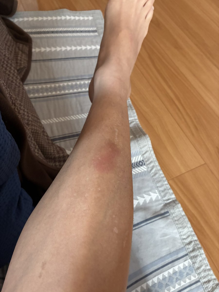 毎回同じところ蹴られて腫れてる