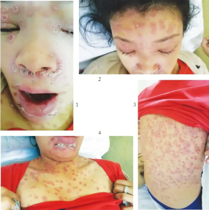 guerreroespejo's tweet image. 18 años♂️, VIH +: ﬁebre y exantema maculo-papuloso descamativo en cara, tronco y extremidades superiores, ligeramente pruriginoso de un mes de evolución.

T-CD4 + 106 cél/µL, carga viral VIH &amp;gt;500 000 copias/mL
½

pesquisa.bvsalud.org/portal/resourc…
#infecciosas #IDX #dermatologia