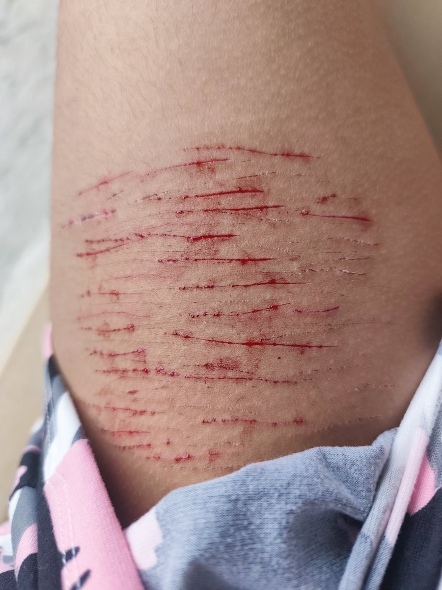jane_luvssh4's tweet photo. Wiped out styros againn lolz #shtwt #SlefHarm #slittwt https://t.co/XxUs36h31r