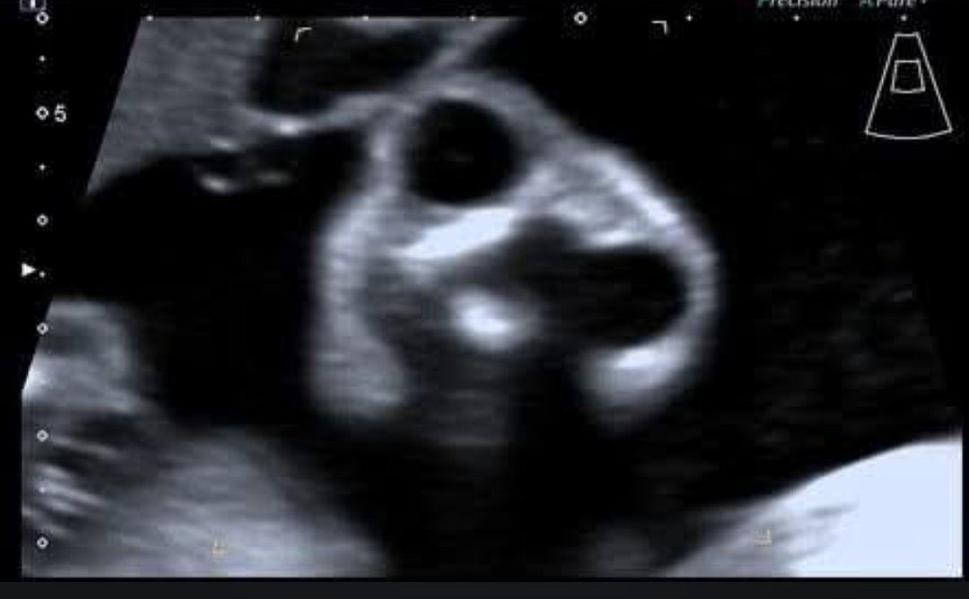 DrAyubaD's tweet photo. Obstetrics Case ;  Anomaly Scan done at late second trimester.

What is this classic appearance called ? 

What is the diagnosis?

What are the causes of this anomaly? https://t.co/HUUFzMBWTF