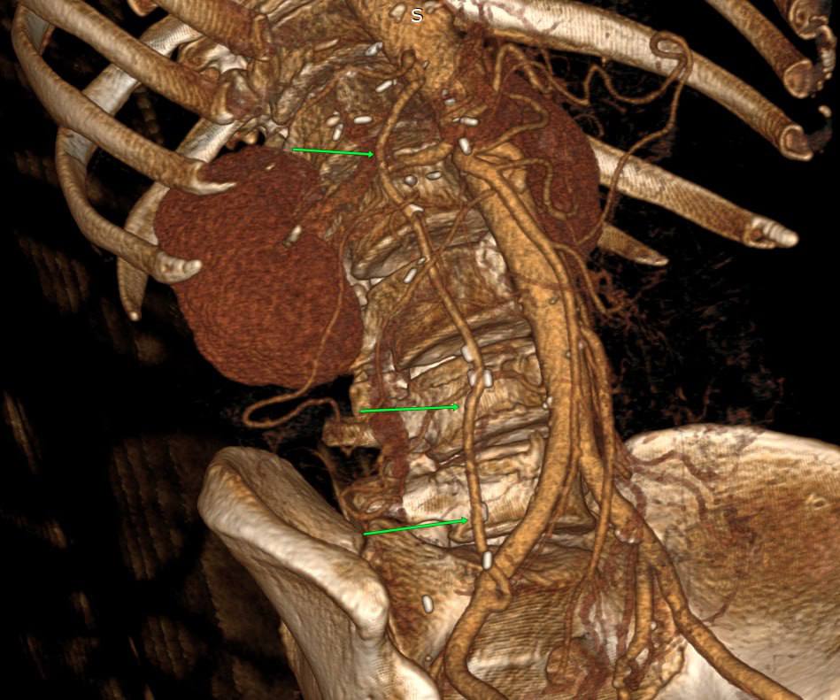 vzixus's tweet photo. Total pancreatectomy with CA, SMA, PV resection (Mayo class 3a)

"Arterial resection and reconstruction-first" concept:
- ilio-hepatic arterial bypass for liver arterialisation (image 1)
-infrarenal SMA transposition (image 2)
- temporary mesocaval shunt

https://t.co/0ouLAQsvQv https://t.co/56QKpVUQGe