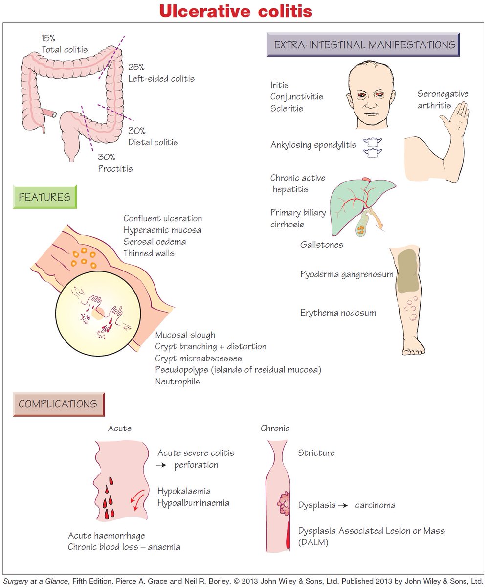 ManualOMedicine's tweet image. Ulcerative Colitis

#medtwitter #foamed #meded