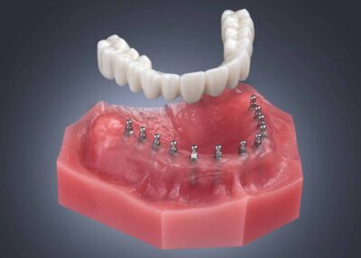 esparzaontario's tweet image. Watch this video by Dr. Bianca Esparza where she explains dental insurance coverage for mini dental implants and denture stabilization. #ontario #implant #dentist bit.ly/3UsAKFl