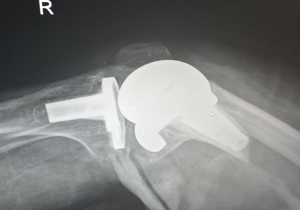 shah_punwar's tweet image. Not something you see every day. Use of the femoral sleeve without a stem clearly produced a transverse stress riser. Concern about a DFR in a late 50s active male but fixation likely doomed to failure #distalfemoralfracture #orthotwitter