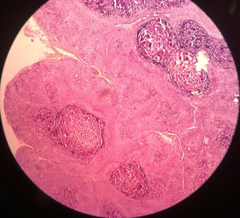 ManjulaNavamani's tweet image. Skin biopsy!!!
Comment your diagnosis...
What is the charecteristic finding observed here???
#pathresidents
#pathx #pathtwitter
#dermatopathology
#learnpathologywithmanju 
@MunchManju95