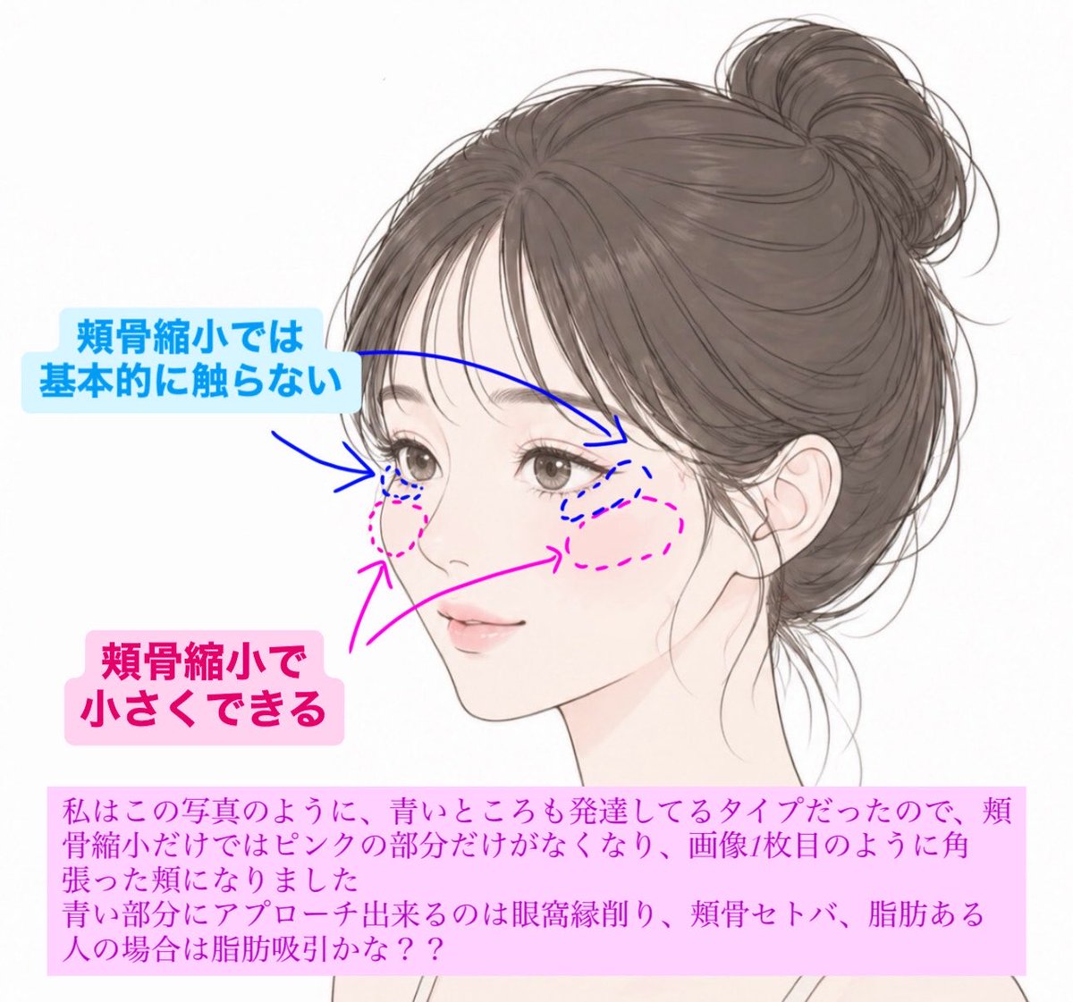 きー@骨切り鼻フルDT tweet media