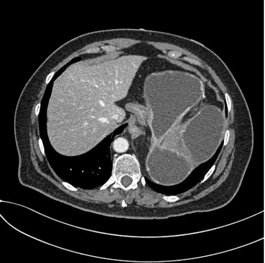 SERAM_RX's tweet photo. Vólvulo gástrico: una patología infrecuente

🔍 Este #PiperSERAM aborda la definición, causas, síntomas y complicaciones del vólvulo gástrico, con especial atención a los hallazgos radiológicos clave para su diagnóstico preciso

Accede aquí 🔗https://t.co/wb3kbNxE4P https://t.co/3gy2HeddNH
