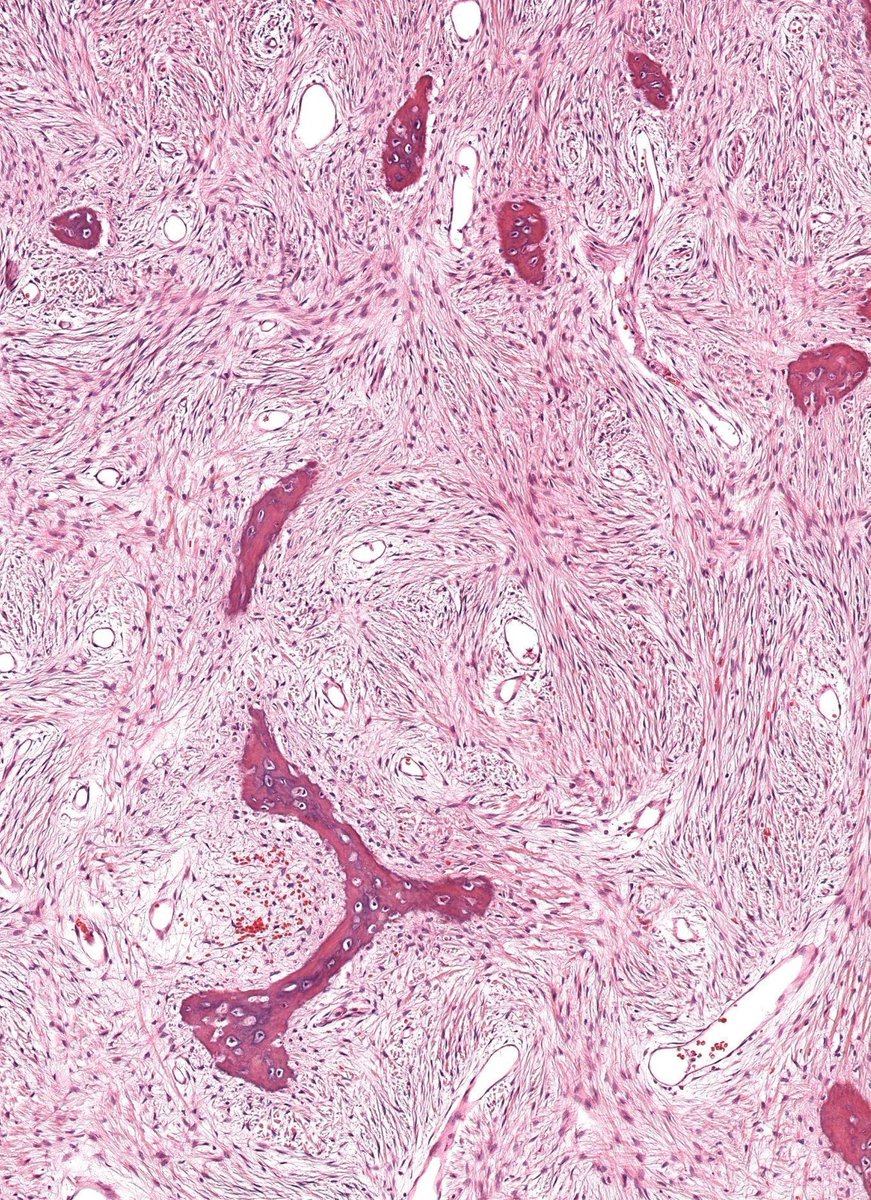 JMGardnerMD's tweet image. Child with expansile intramedullary bone lesion. 
Diagnosis ✅ youtu.be/e0B1MSg_TRw?si… 
What syndromes can this occur in? What gene mutation? 
Answers &amp;amp; WSI digital slide: kikoxp.com/posts/22455
#BSTpath #pathologists #pathTwitter #orthotwitter #radpathmatch #radiology