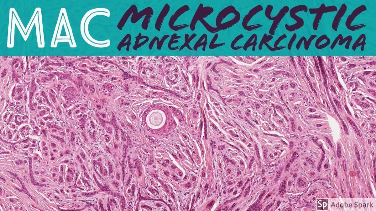 JMGardnerMD's tweet image. Microcystic adnexal carcinoma (MAC). A rare entity; easy to miss if unfamiliar. My 5 Min video: buff.ly/30VmB6s. Digital slide: pathpresenter.net/public/display…. @ mydermpath @ pathpresenter #pathology #pathologists #pathTwitter #dermpath #dermatology #dermatologia #dermtwitter