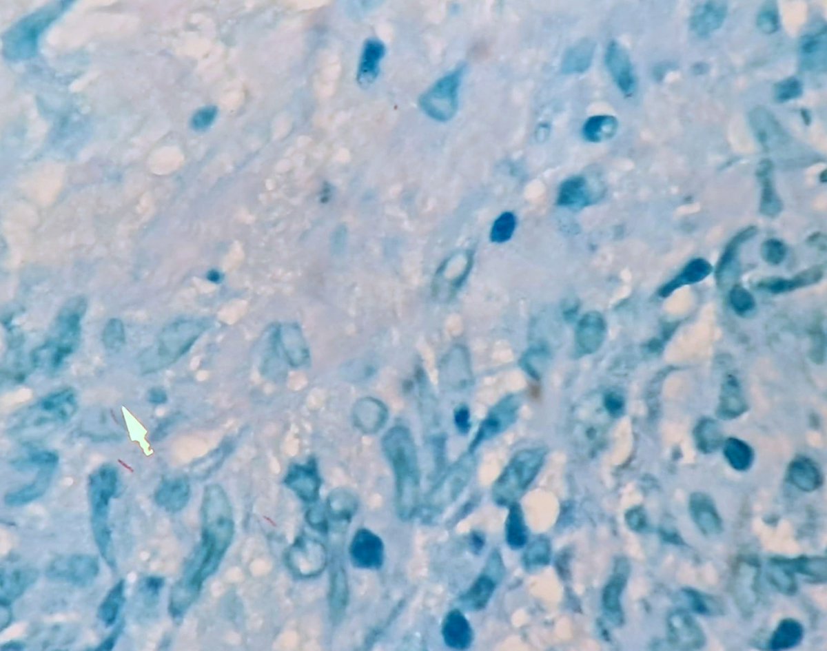 ConsejosReumato's tweet photo. Varón con #dermatomiositis recibía #prednisona y MMF, desarrolló aumento de volumen del brazo derecho, la RMN reveló proceso inflamatorio en bíceps, la biopsia muscular reveló granulomas y la coloración Ziehl Neelsen mostró bacilo tuberculosos (foto). No presentó TB pulmonar. https://t.co/jxsbzEnhEb