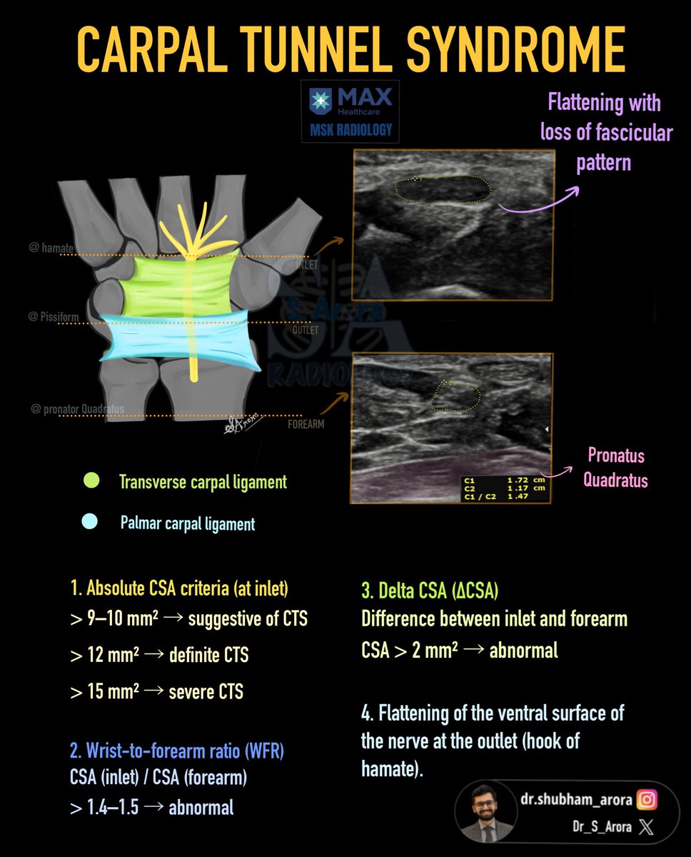 Dr_S_Arora's tweet photo. Slide on carpal tunnel syndrome. 

https://t.co/55BpiZksxa https://t.co/Me6N8Q5kLe