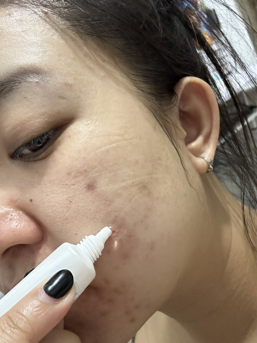 fahfeak's tweet photo. เจลแต้มสิวกาชูว์ KACHU ACNE ADVANCE GEL เราใช้ทั้งผิวหน้าและผิวตัว คือสามารถใช้ได้กับสิวทุกประเภท ใช้แล้วสิวยุบเร็ว ไม่ทิ้งรอย ผิวชุ่มชื้น ลดการเกิดสิวใหม่ หลังสงกรานต์คือสิวขึ้นหนักอยู่นะ  ได้ตัวนี้มาช่วยเริสๆเลย 

#เจลแต้มสิวกาชูว์ #KACHU #สิวอักเสบ #สิวตัว #สิวผดที่หน้าอก https://t.co/TZF8I0Zd7y