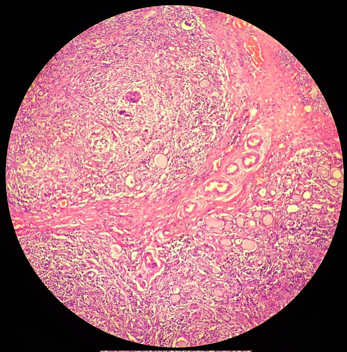SyedSal55391459's tweet image. #histopathology
#thyroid
#pathX
#pathTwitter
#photomicrograph
Dx: De Quervain's thyroiditis ( subacute granulomatous thyroiditis).